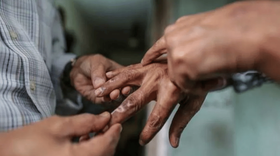 indore news sparsh leprosy awareness campaign to begin from january 30