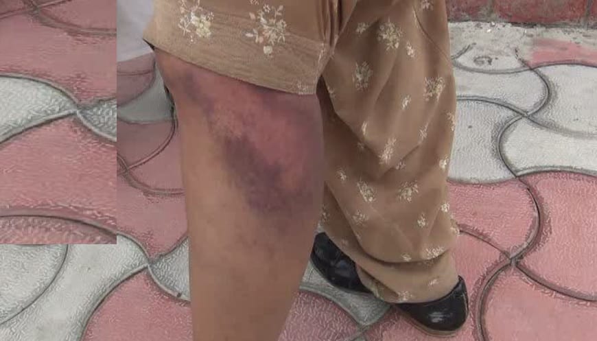 Kanpur Daughter in law and son break elderly mothers teeth and ribs police instead of justice lock her room
