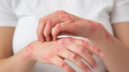 Leprosy Prevention Day: If you find symptoms of leprosy, get your family members tested too, don't hide it.