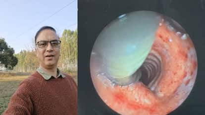 IGMC Shimla doctors removed a live, eight inch long leech from a patient's throat