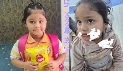 Girl cheeks cut by chinese manjha