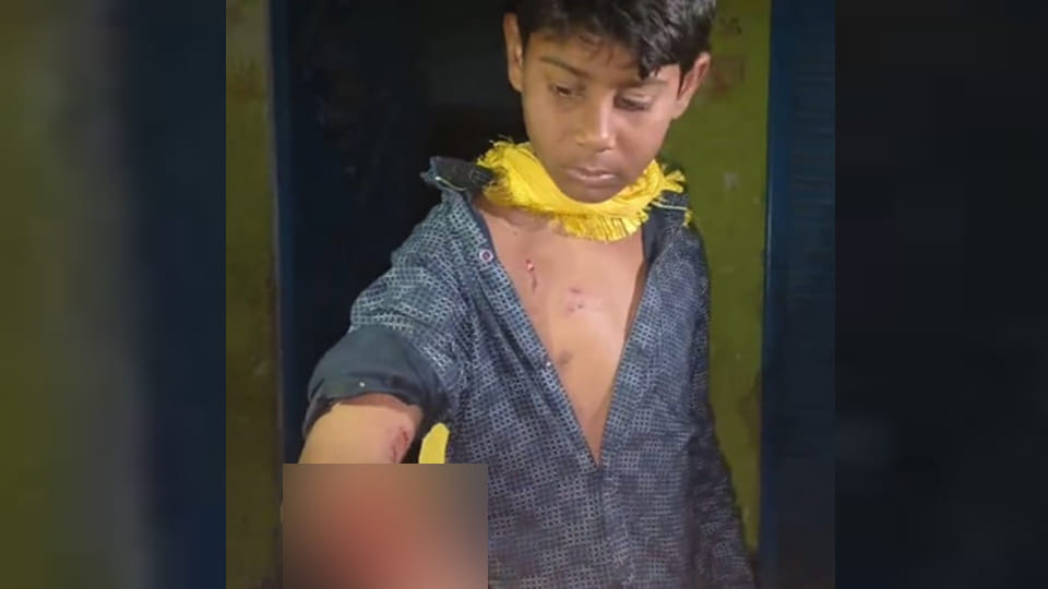 Hamirpur: Teenager left bleeding profusely after attack by a Rottweiler dog