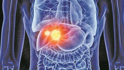 UP: यूपी में बढ़ेगा कैंसर जांच का दायरा, तुरंत शुरू होगा इलाज; मामलों में 15 फीसदी तक गिरावट लाने का लक्ष्य UP expands cancer screening coverage, begins treatment immediately aims to reduce cases by 15%