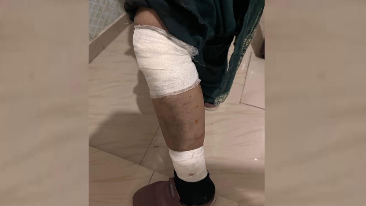 Lucknow: Dogs chase and attack woman, tearing flesh from her leg