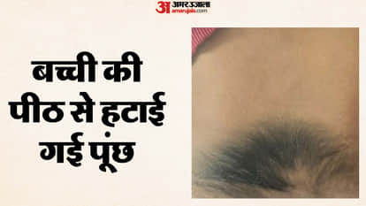 Girl born with tail undergoes operation Jhalawar Medical College gives her new life