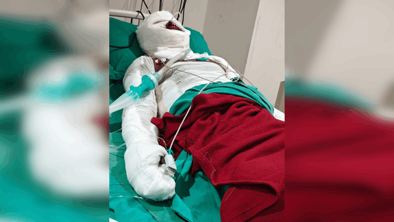 मंगल कार्बन प्लांट में झुलसी मासूम की हुई मौत