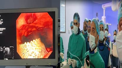 Shimla: Chamiyana Hospital achieves milestone, successfully uses EUS cystogastrostomy