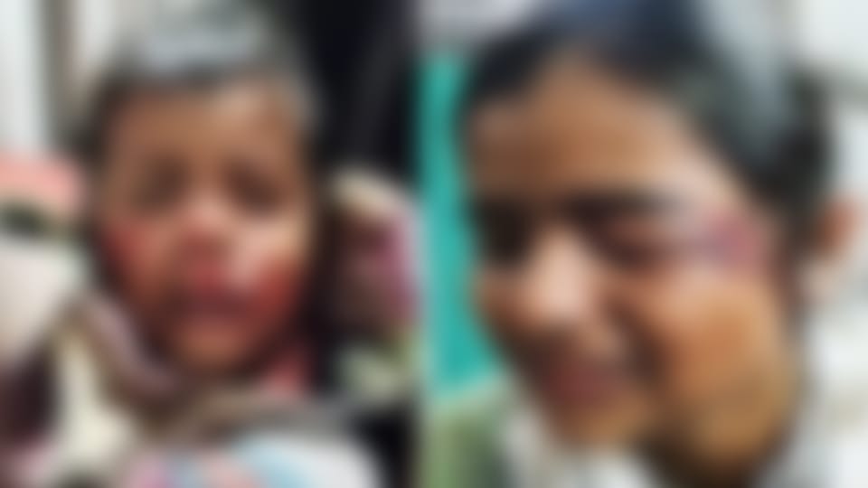 Saharanpur: Terror of ferocious dogs, scratched the face of a four year old child, got 50 stitches