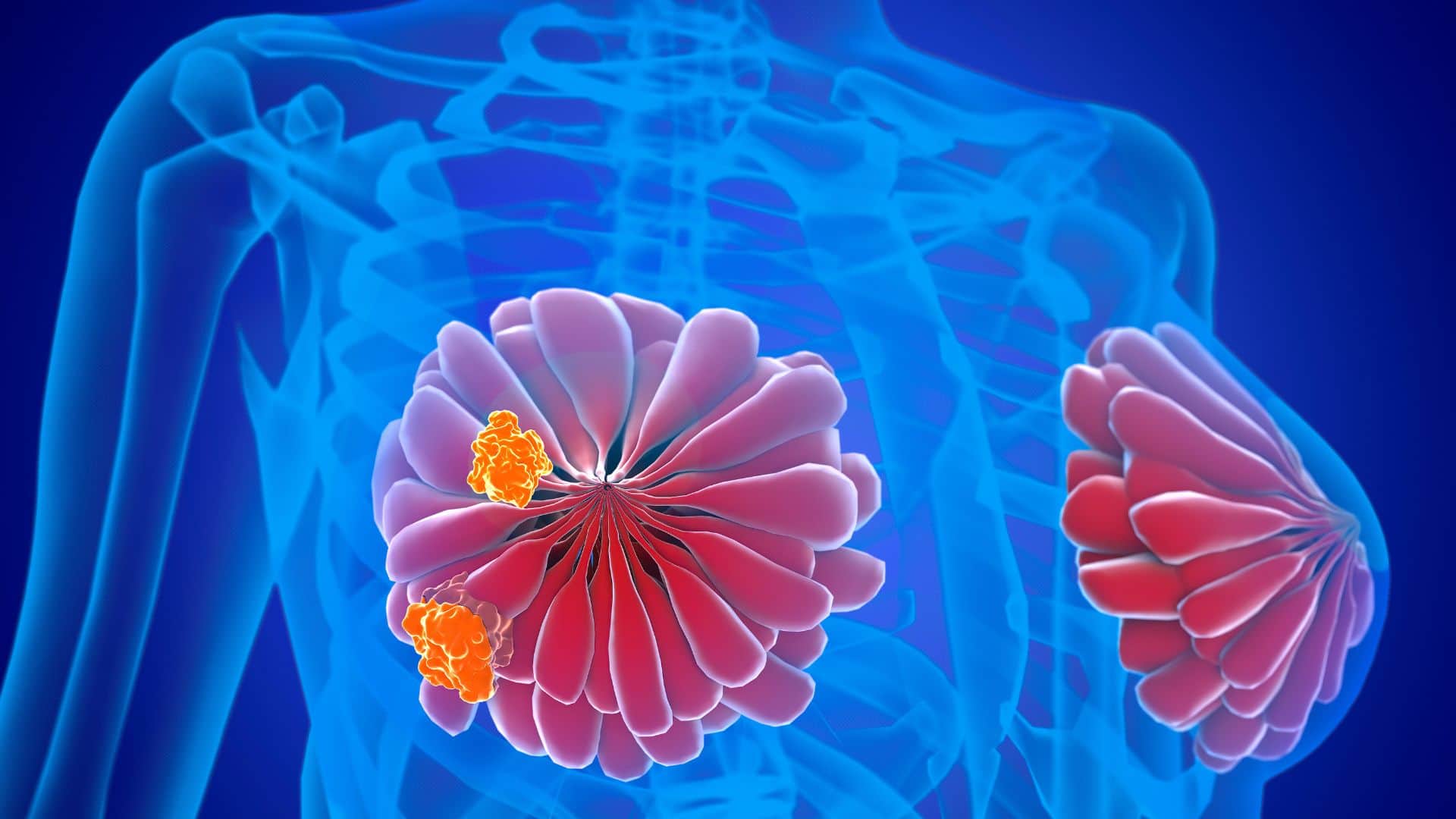 Are All Breast Lumps Cancerous? Study Shows 80% Lumps are Non-Cancerous: Benign vs Malignant Signs