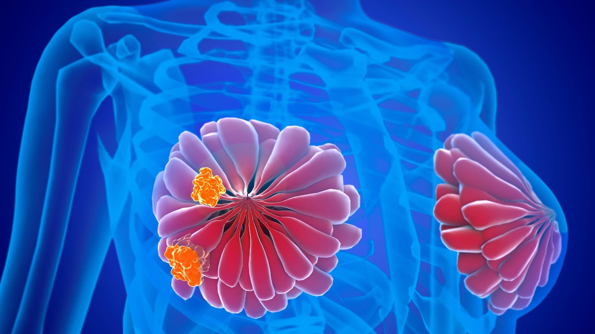 Are All Breast Lumps Cancerous? Study Shows 80% Lumps are Non-Cancerous: Benign vs Malignant Signs