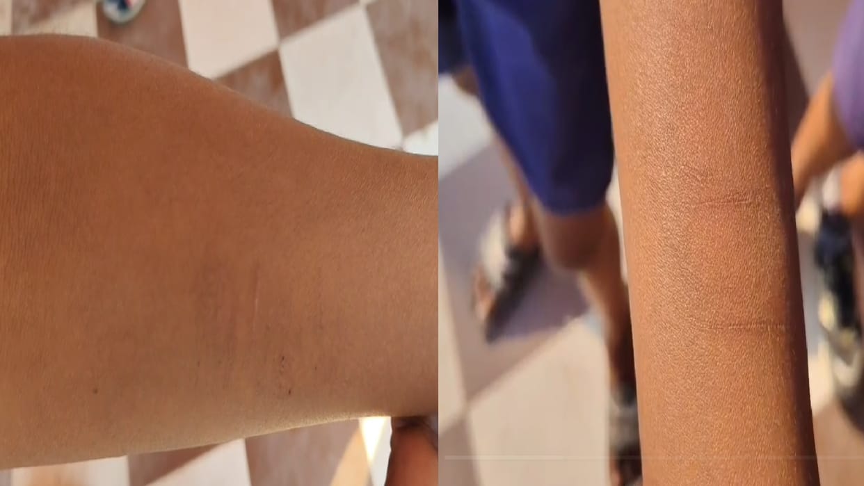 CG News: 35 schoolchildren slit their wrists, sparking a family complaint