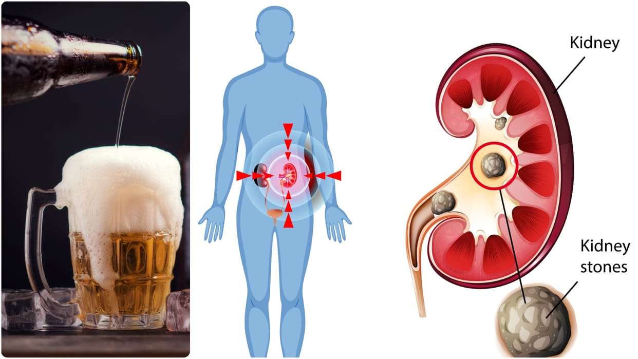 myths and Facts About Beer and Kidney Stones know beer peene se kidney stone nikalta hai kya