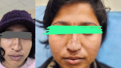 4-Hour Rhinoplasty Transforms Young Woman’s Life at SN Medical College