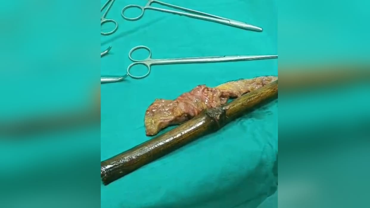 A piece of bamboo stuck in the stomach for several days was removed, stitches were applied in the first treatm