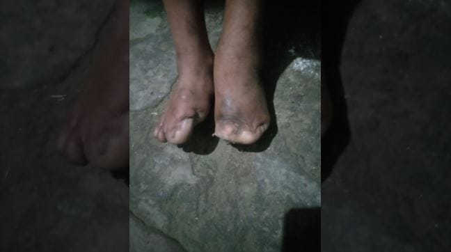 Rats gnawed toes of an innocent child poverty is giving pain for 14 years Now government ointment will be appl