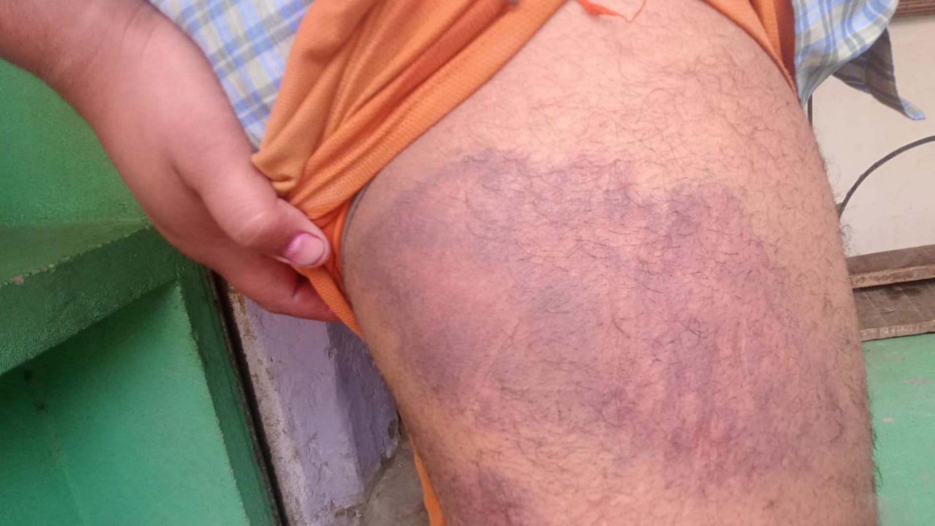 पुलिस की पिटाई से बने निशान।