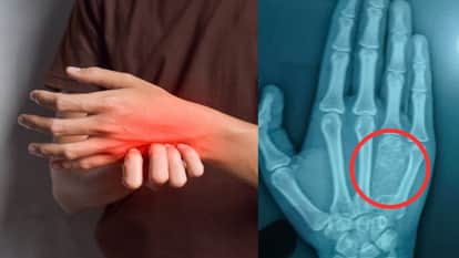 Understanding Bone Cysts in Adolescents Why Rapid Growth in Teen years Increases the Risk of Bone Cavities