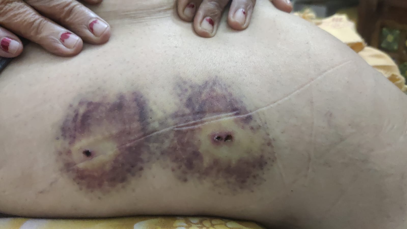 महिला को कुत्तों ने बुरी तरह काटा