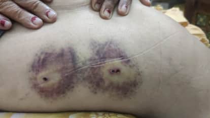woman who went for walk in Greater Noida bitten by dogs