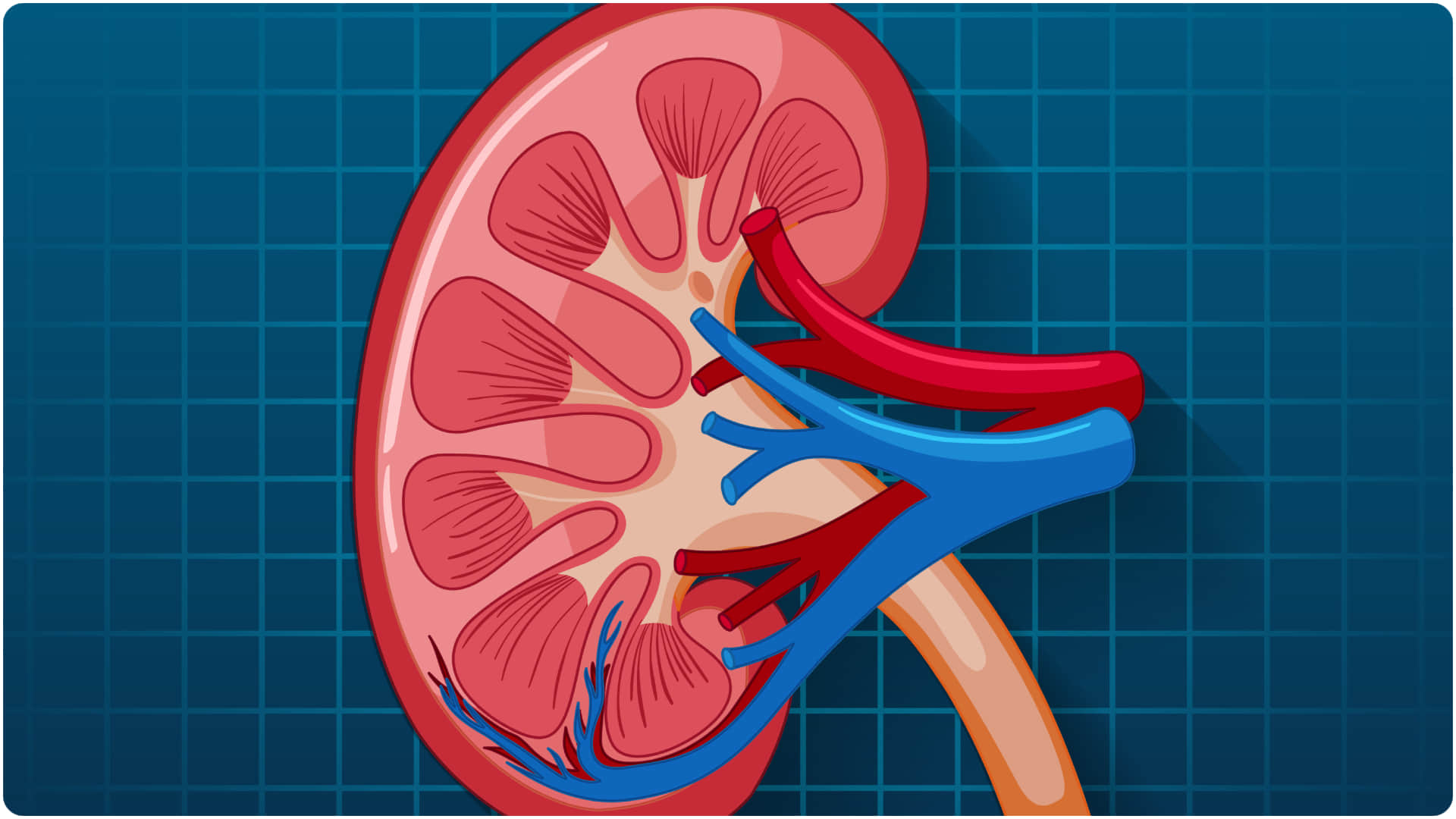 too much Calcium and Vitamin D supplement increase risk of kidney stones