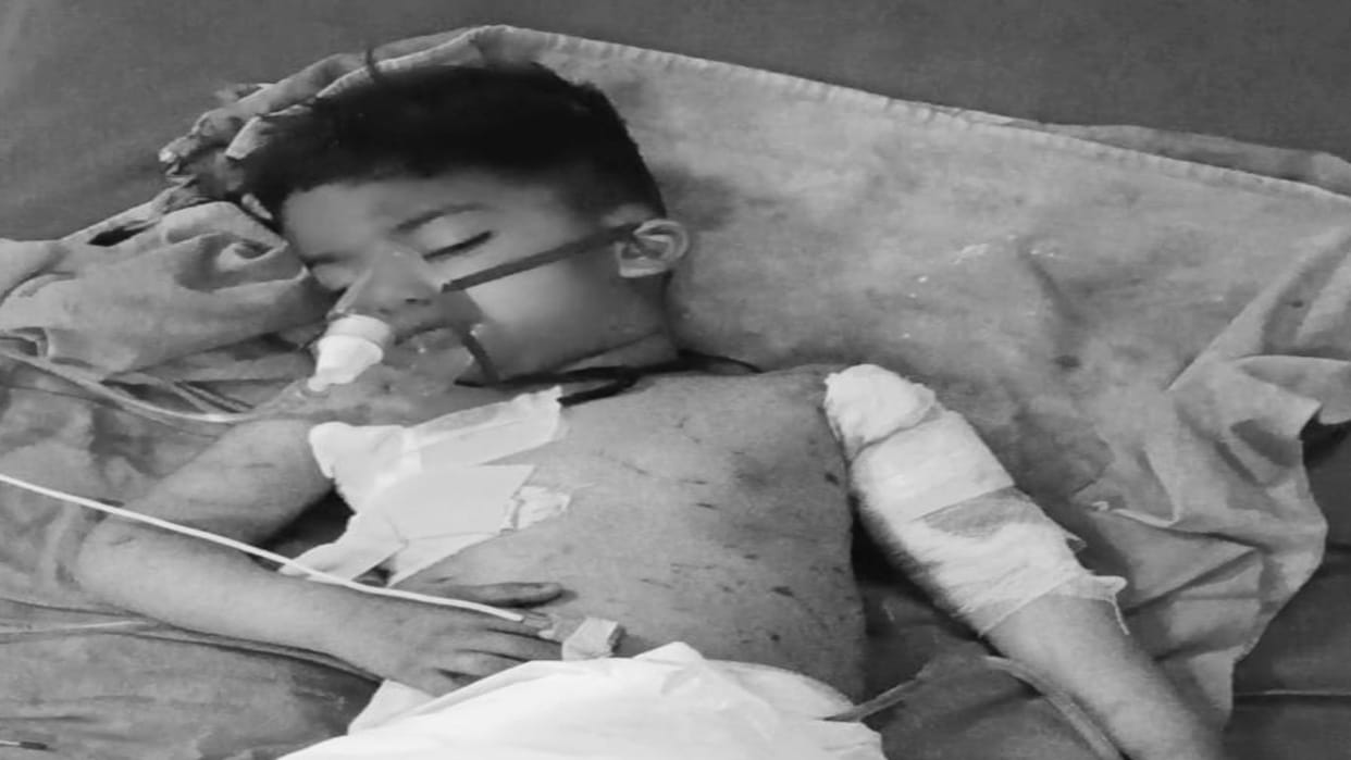 Stray Dogs Attack Four-Year-Old Child Flesh Torn from Multiple Spots in Bareilly