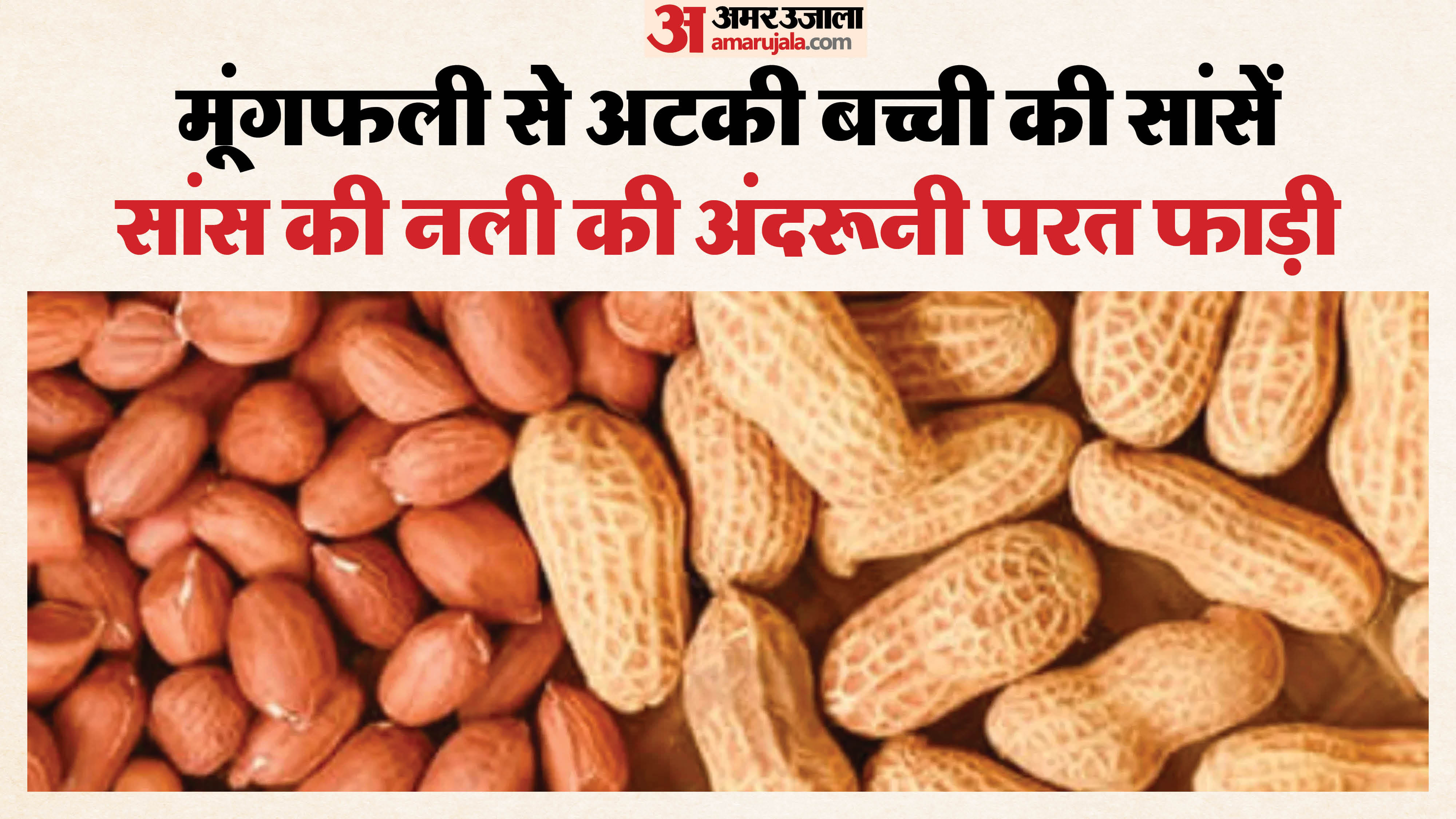 बच्ची के गले में फंसी मूंगफली