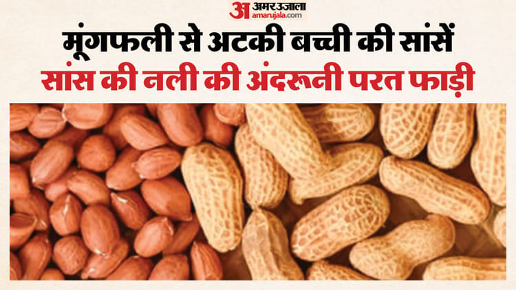 मूंगफली ने फुलाया दम: डेढ़ साल की बच्ची की सांस की नली में फंसी, शरीर में घटती जा रही थी ऑक्सीजन, ऐसे बची जान