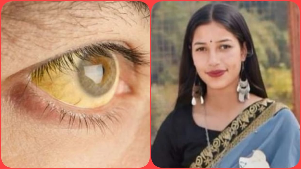Himachal Jaundice Outbreak Spirals Out of Control in Gohar Mandi 19 Year Old Newlywed Dies at PGI