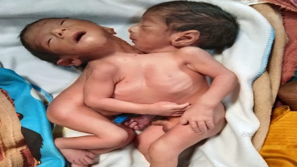 Mother dies upon seeing babies with two heads and four limbs