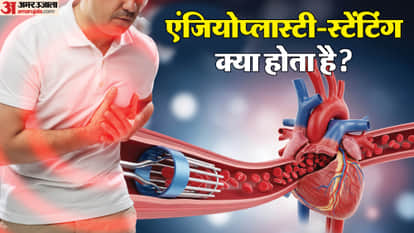 हार्ट अटैक और स्टेंटिंग की प्रक्रिया