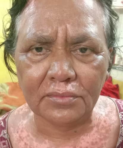 A case of negligence during therapy has come to light in AIIMS Jammu.