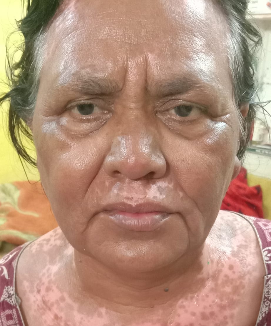 A case of negligence during therapy has come to light in AIIMS Jammu.