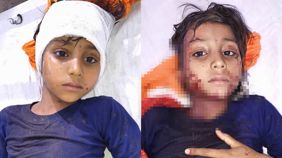 कांठ में तेंदुए के हमले में घायल छात्राएं