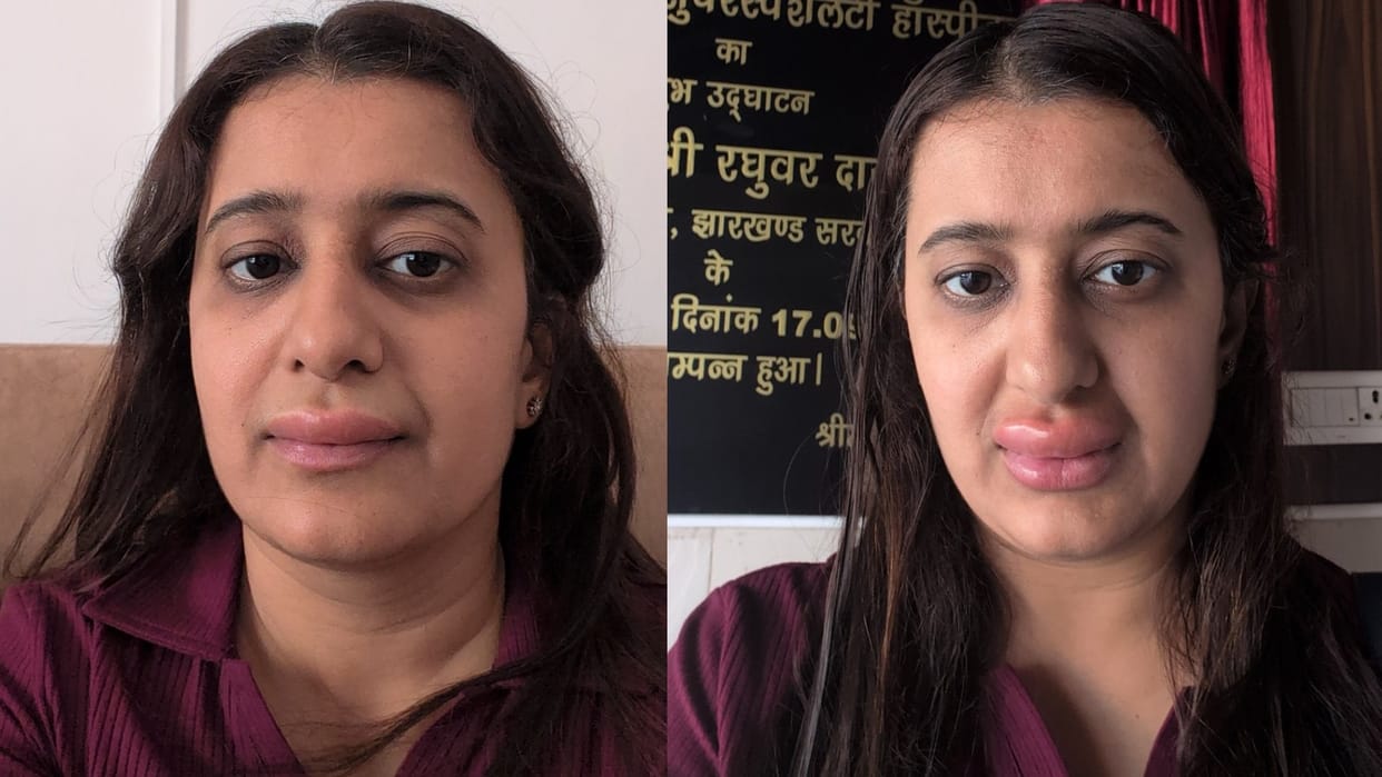 Viral Trending News ranchi woman alleges food allergy in vande bharat express irctc news