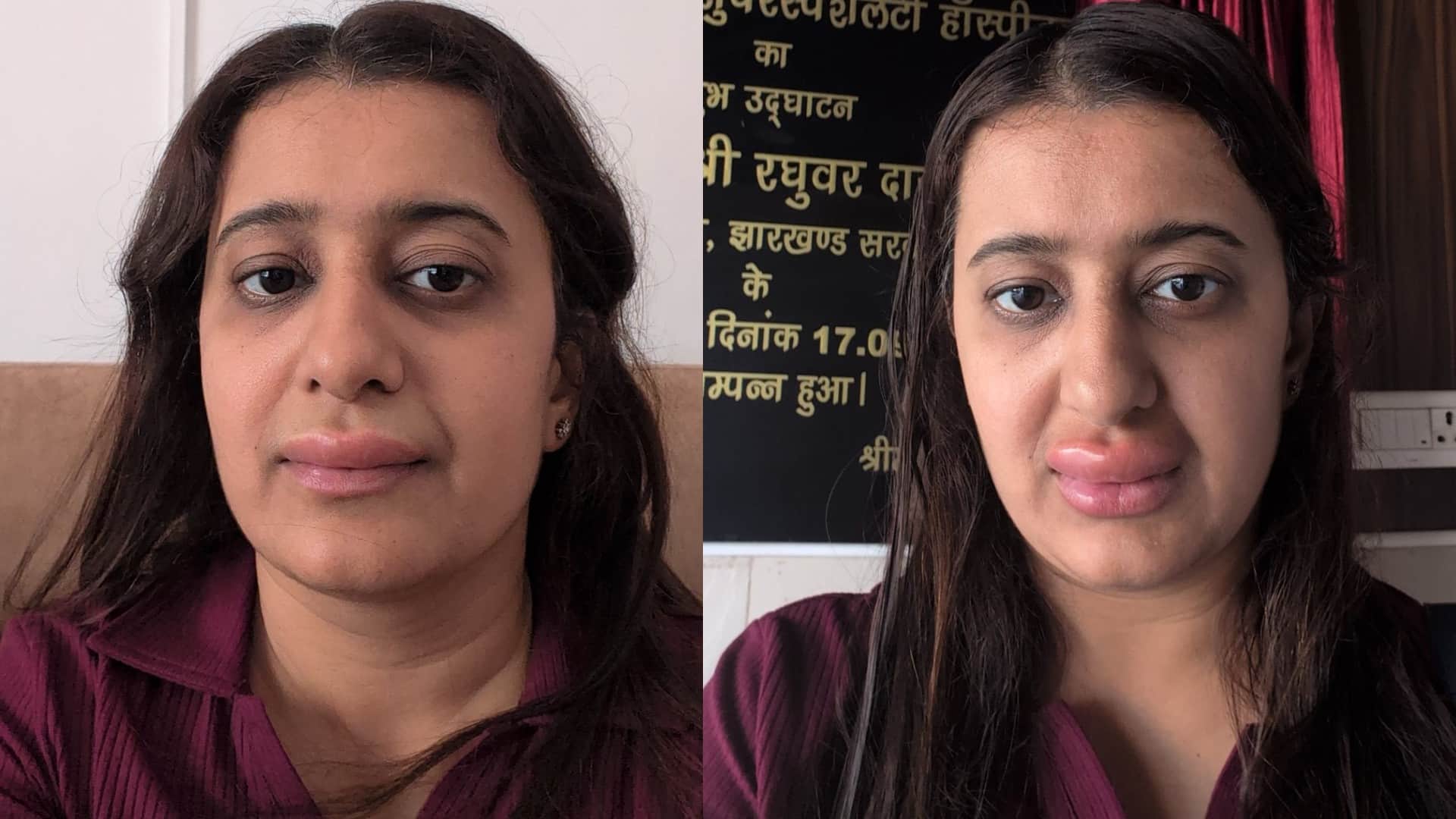 वंदे भारत में खाना खाने से महिला की बिगड़ी हालत और सूज गए होठ