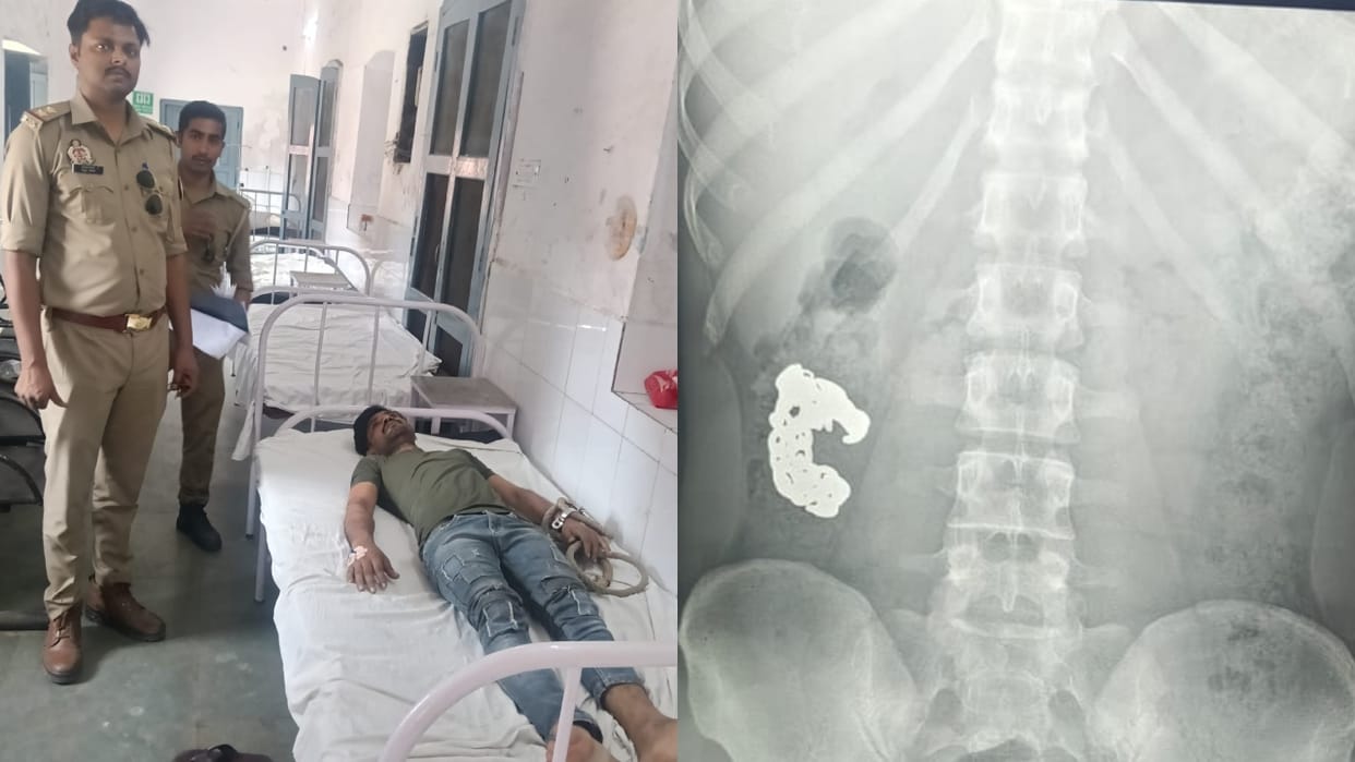 Thief Swallows Silver Bracelet in Bareilly Police Adopt This Method for Recovery