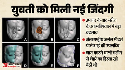 PGI Doctors and PU Engineers Rebuild Young Woman Face Using Hybrid Technology Details in Hindi