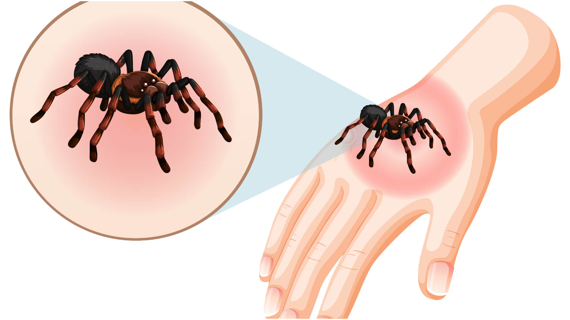 Spider Bites Symptoms and risk factors How does spider venom affects human
