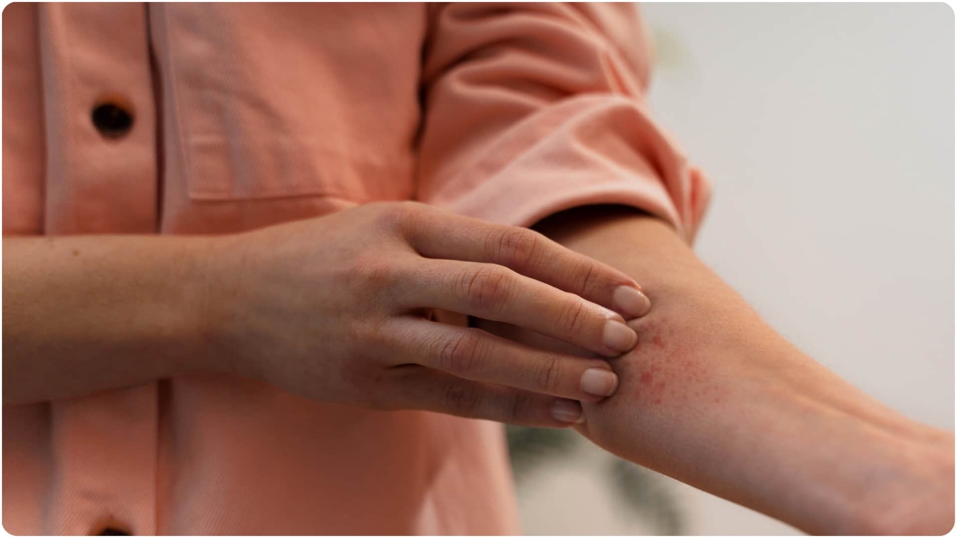 कीड़े काटने से स्किन इंफेक्शन