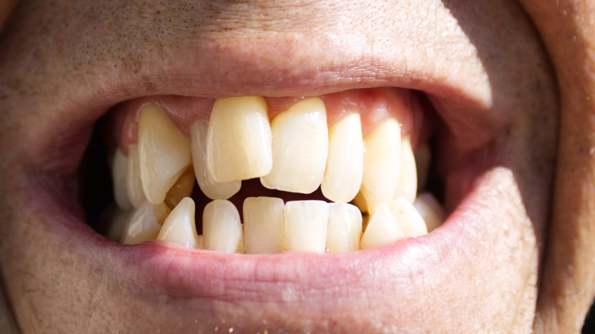 right way to brush Crooked Teeth in hindi tede mede dant me brush kaise kare