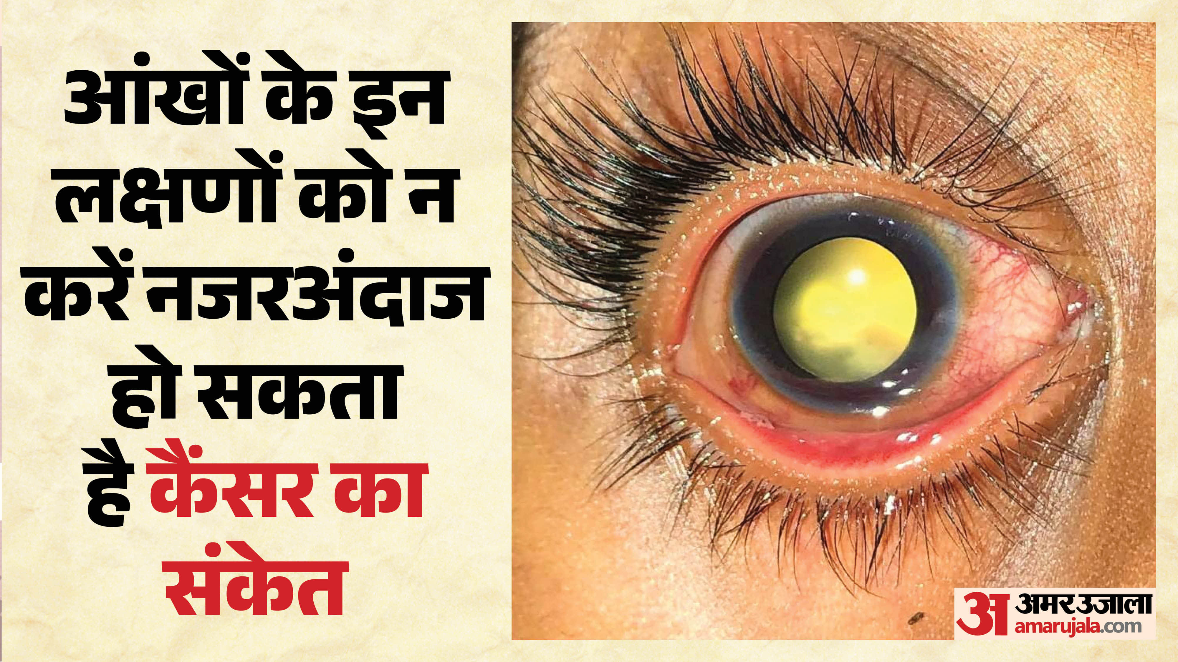 बच्चों की आंख में कैंसर