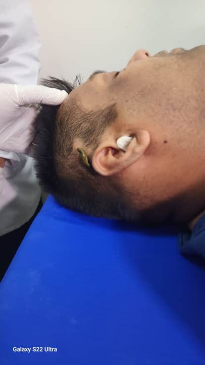 Leech Therapy Emerges as Affordable and Effective Treatment for Hair Loss and Skin Disorders in Jaipur