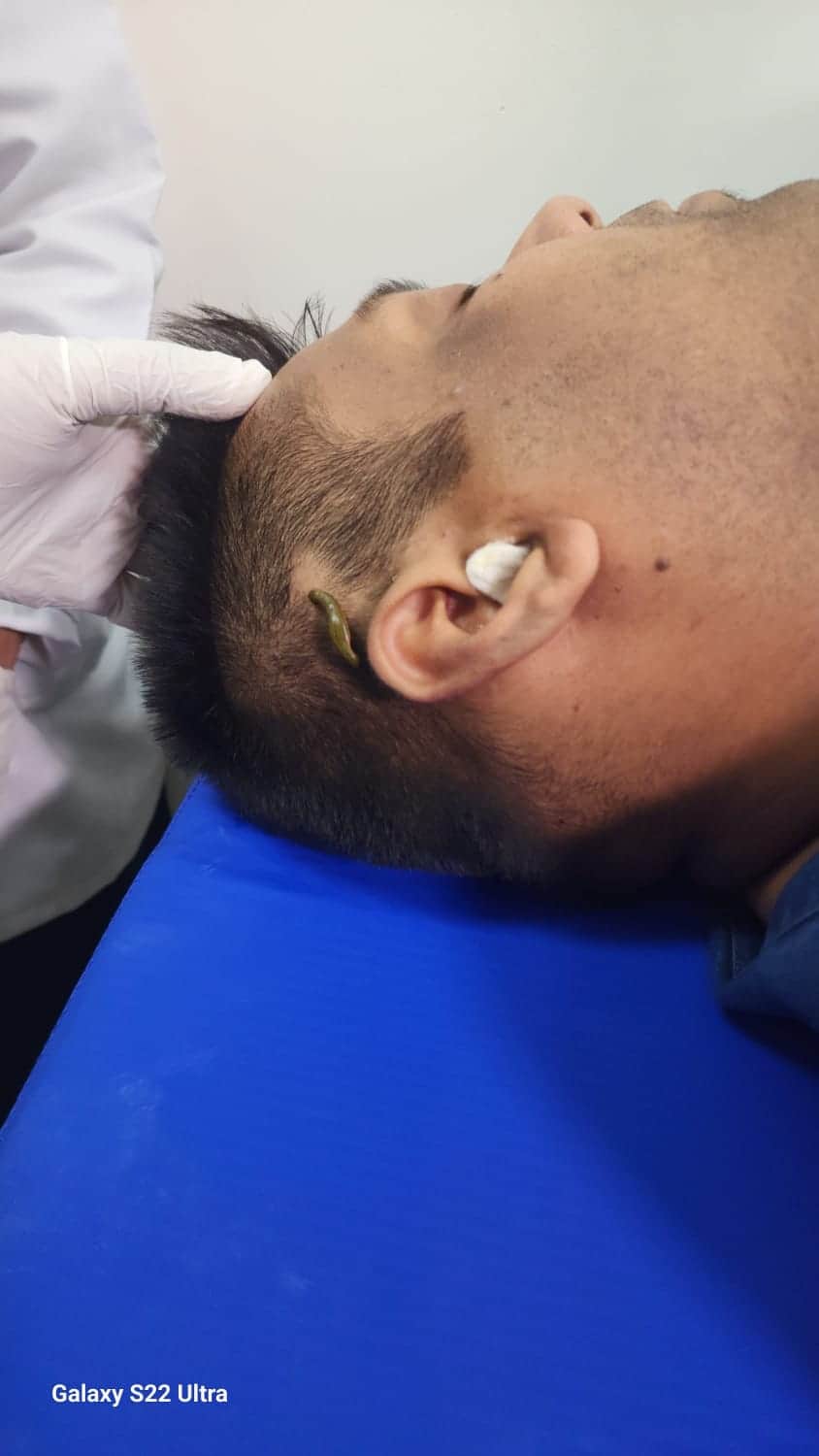 लीच थैरेपी