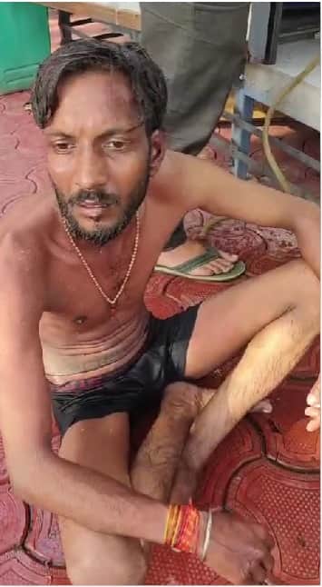 Bhopal News: Trader Sets Himself on Fire Amidst Anti-Encroachment Drive; Allegations of Selective Action Again