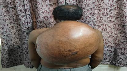 Amazing feat at Raipur's Ambedkar Hospital: Doctors create history by removing a tumor weighing over 10 kg
