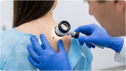Derm Zero new AI smartphone app that can diagnose Deadly skin cancers at home