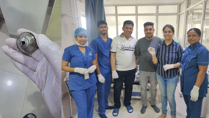 Indore News Doctors Save 6 Month Old Baby After He Swallowed Steel Lid