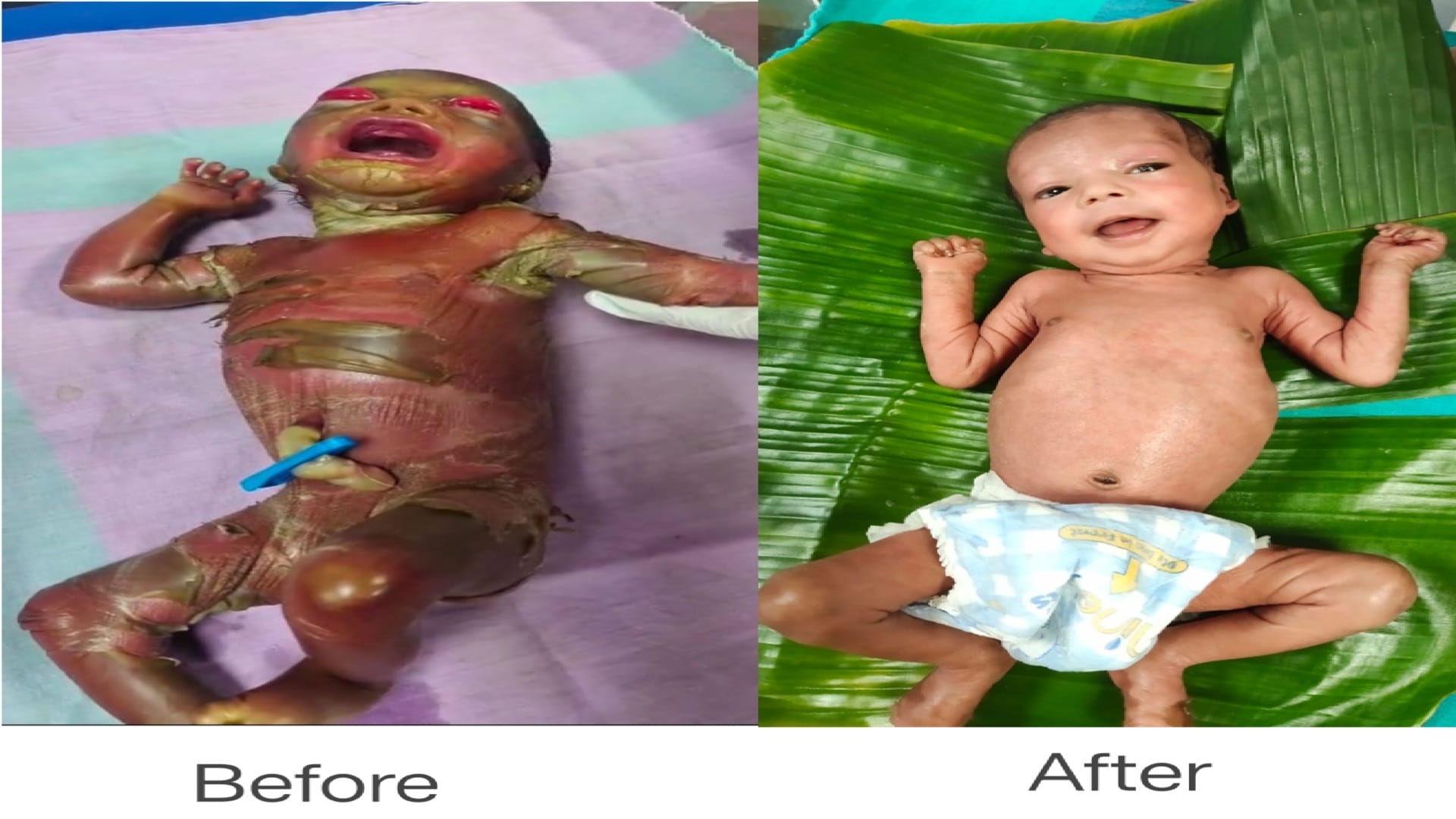 SNCU में दुर्लभ बीमारी पर जीत