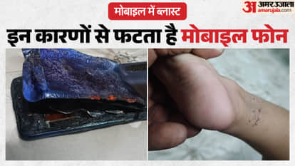 Aligarh News Toddler Burned as Mobile Phone Battery Explodes While Watching Cartoon
