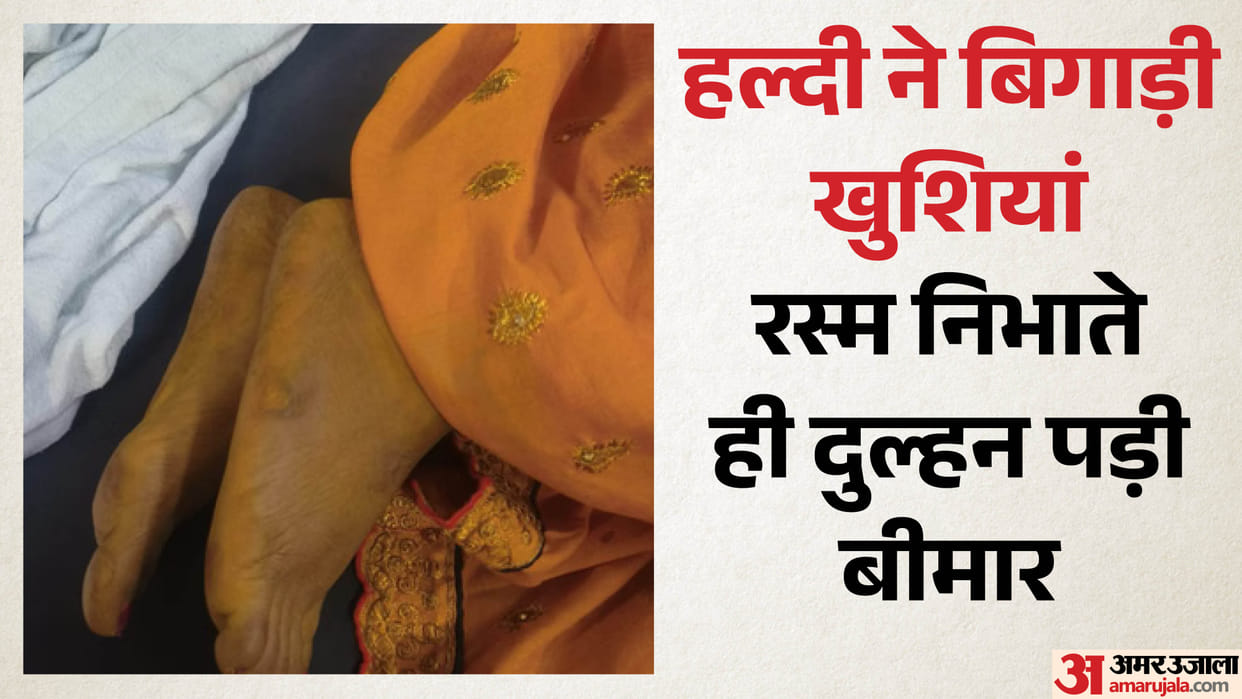 Indore: Adulterated turmeric causes allergic reaction in bride, hospitalized